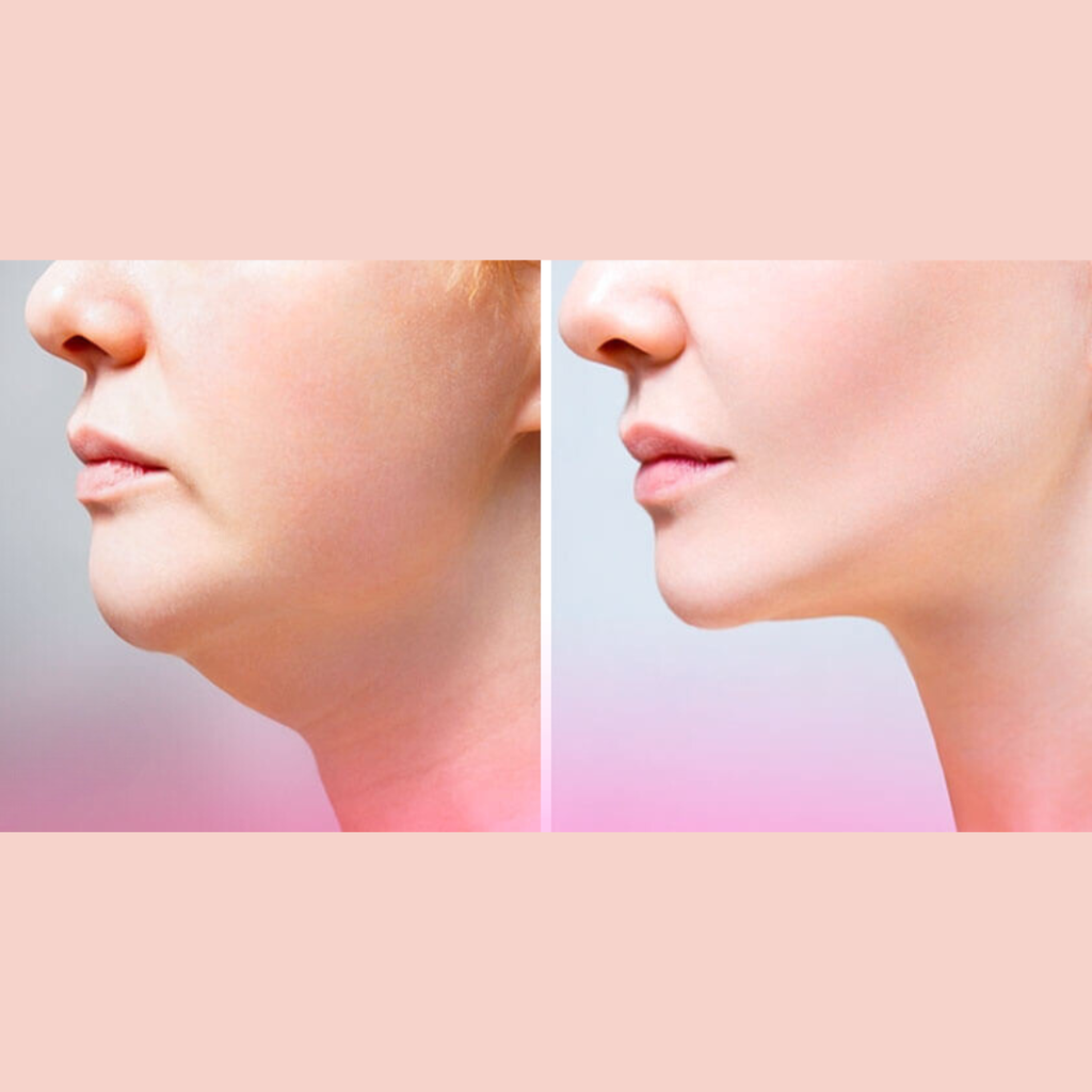 Lipopapada + Perfilamiento