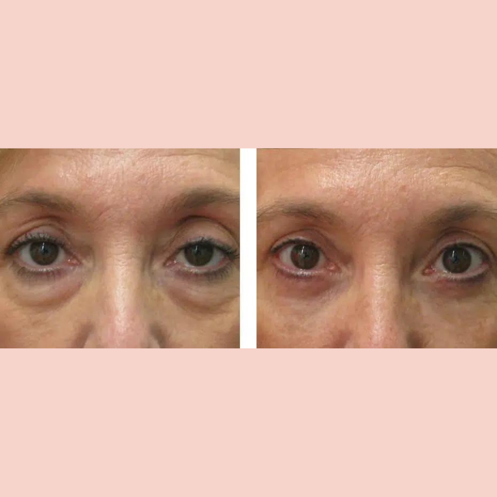 Blefaroplastia Superior