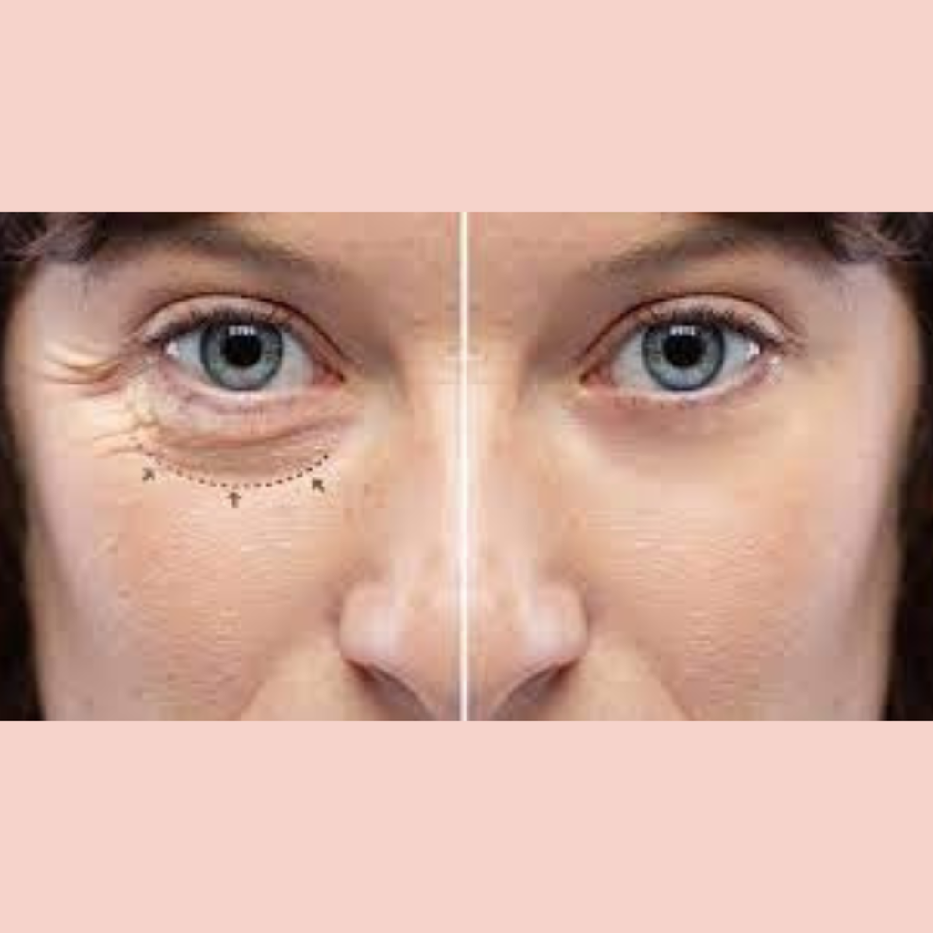 Blefaroplastia Inferior