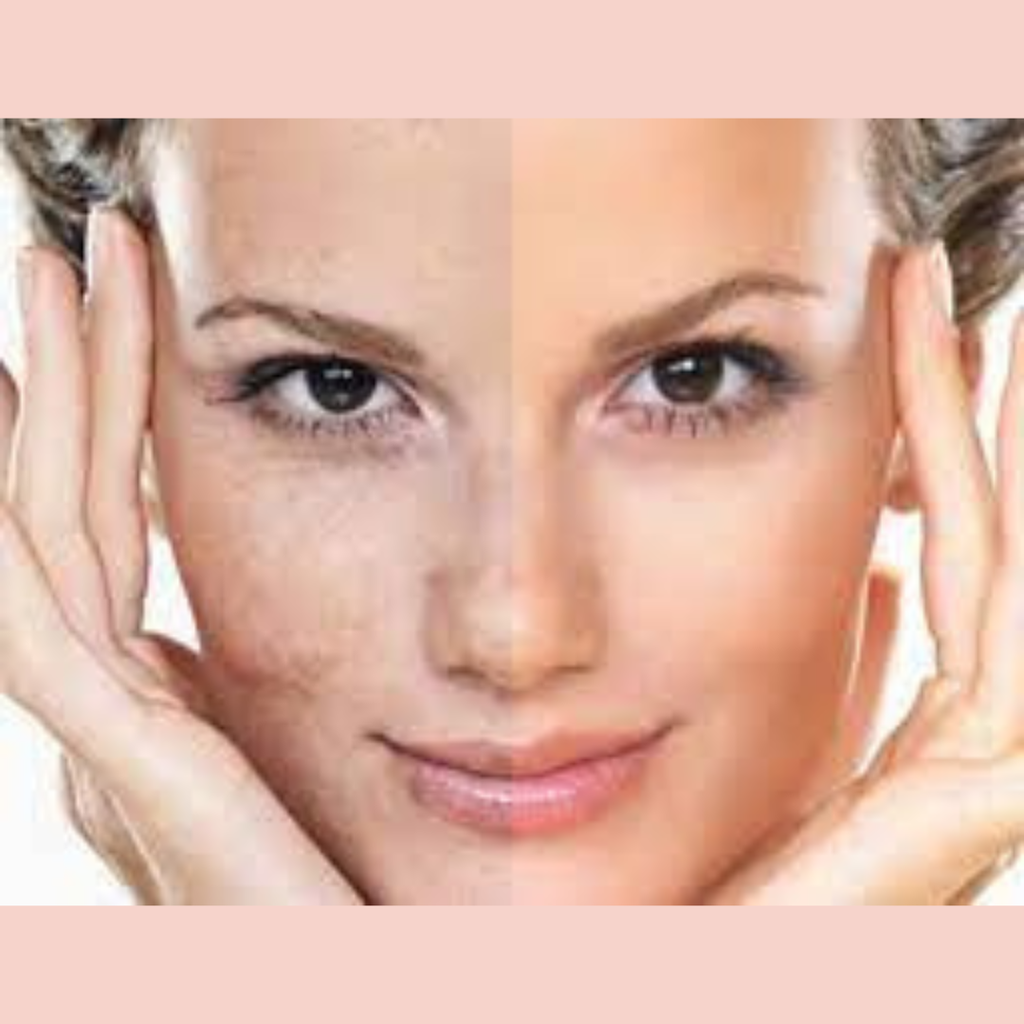 Porcelanización Facial